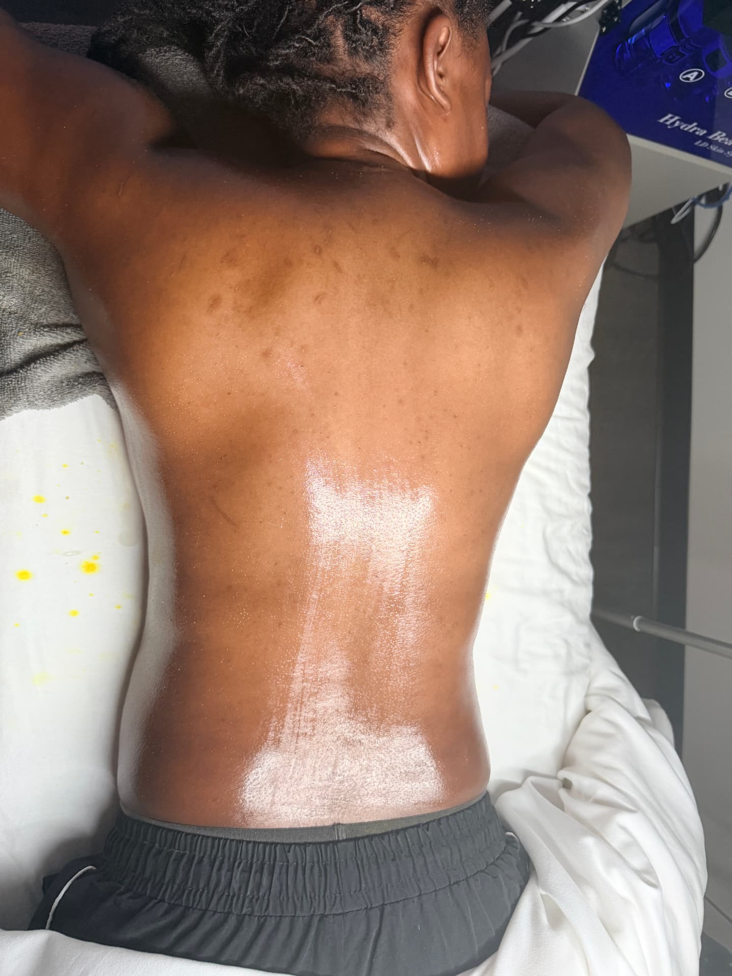 Client's back after a body treatment for congestion and post-breakout marks